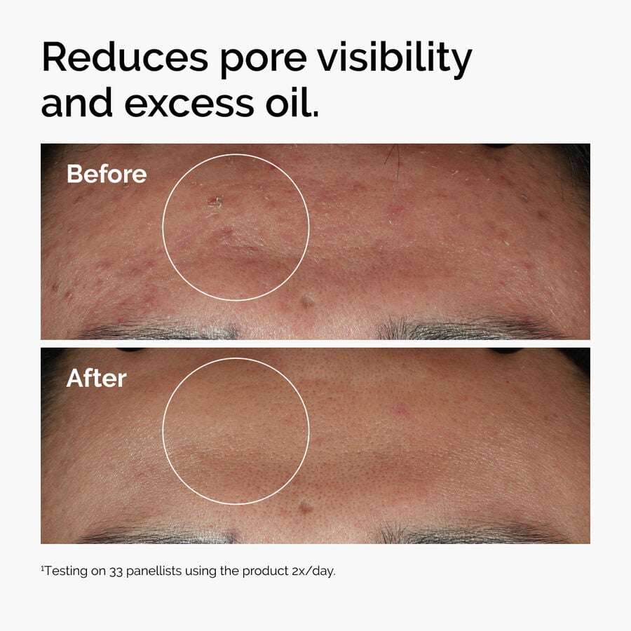 niacinamide-10-zinc-1-d5 ord-niacinamide-zinc-blemish-serum-before-after-pores.jpg