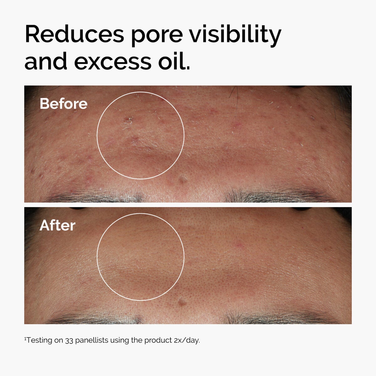 niacinamide-10-zinc-1-d5 ord-niacinamide-zinc-blemish-serum-before-after-pores.jpg