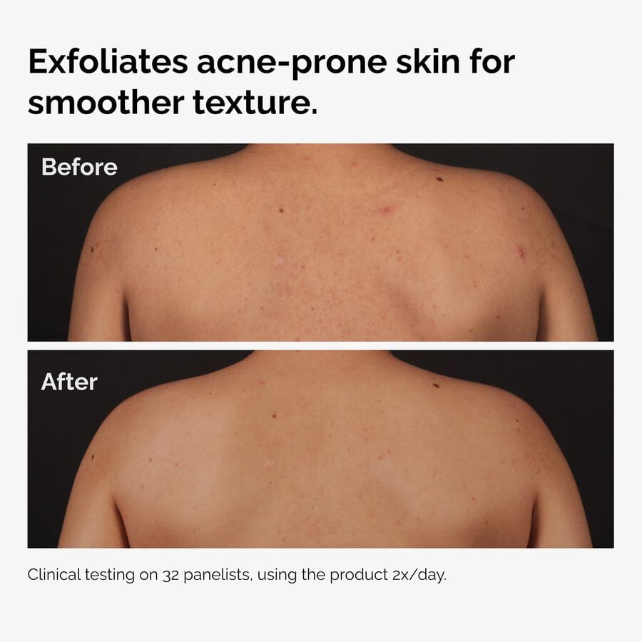 salicylic-acid-0-5-body-serum-z8 ord-salicylic-acid-body-serum-before-after-graphic-NA.jpg